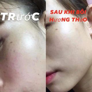 Thảo dược thiên nhiên Hương Thảo (xóa mờ nám-tàn nhang)