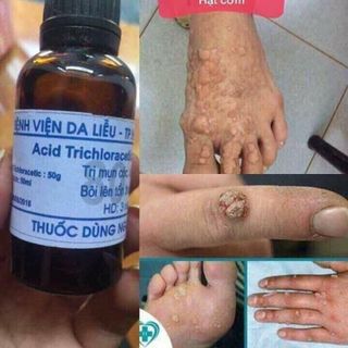 TRỊ MỤN CÓC, MỤN CƠM của BV DA LIỄU TPHCM