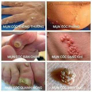 TRỊ MỤN CÓC, MỤN CƠM của BV DA LIỄU TPHCM