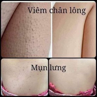 Trị dứt điểm các loại mụn ở mặt, lưng...từ thảo mộc thiên nhiên