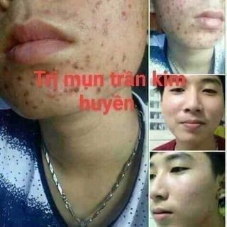 Trị dứt điểm các loại mụn ở mặt, lưng...từ thảo mộc thiên nhiên