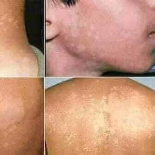 Điều trị dứt điểm lang ben, hắc lào, vảy nến...