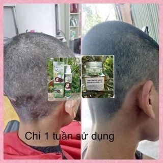Trị dứt điểm nấm da đầu, trị gàu, giúp mọc tóc từ thiên nhiên