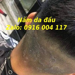 Trị dứt điểm nấm da đầu, trị gàu, giúp mọc tóc từ thiên nhiên