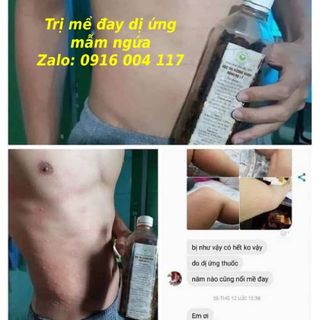 Trị nổi mề đay sau sinh, dị ứng thời tiết...từ thảo mộc thiên nhiên
