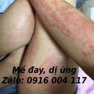 Trị nổi mề đay sau sinh, dị ứng thời tiết...từ thảo mộc thiên nhiên