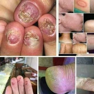 Đặc trị viêm da cơ địa, nấm móng, vảy nến, á sừng các loại