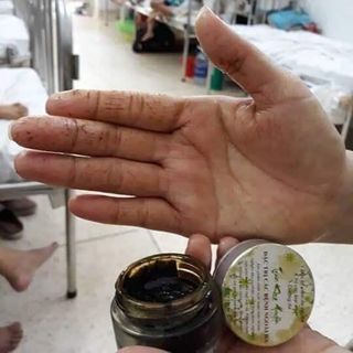 Đặc trị viêm da cơ địa, nấm móng, vảy nến, á sừng các loại