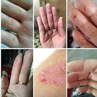 Đặc trị viêm da cơ địa, nấm móng, vảy nến, á sừng các loại
