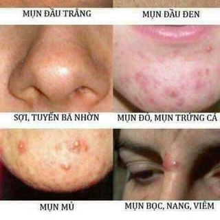 Trị dứt điểm các loại mụn ở mặt, lưng...từ thảo mộc thiên nhiên
