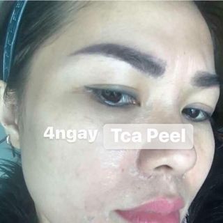 TCA PEEL USA - CHẤM TÀN NHANG