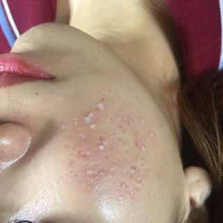 Buôn sỉ chấm tàn nhang - sẹo rỗ - đồi mồi