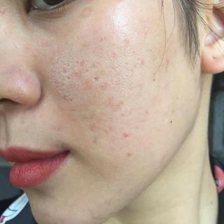 Buôn sỉ chấm tàn nhang - sẹo rỗ - đồi mồi