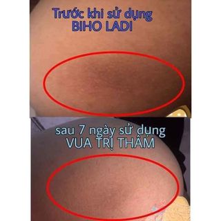 Siêu dưỡng thâm 5S biho ladi trị thâm khử mùi nách bẹn mông bikini