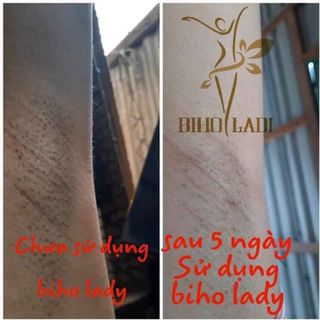 Siêu dưỡng thâm 5S biho ladi trị thâm khử mùi nách bẹn mông bikini