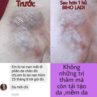 Siêu dưỡng thâm 5S biho ladi trị thâm khử mùi nách bẹn mông bikini