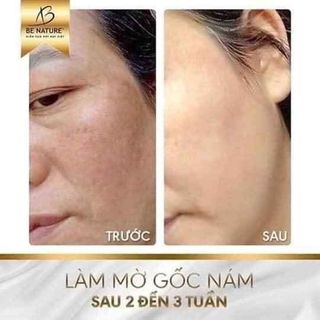 Kem trị nám tàn nhang Blanc melasma