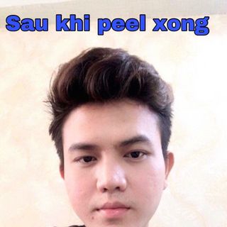 TCA PEEL ĐẶC TRỊ SẸO RỖ