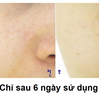 Tinh chất thu nhỏ lỗ chân lông Professional formula Pore ampoule