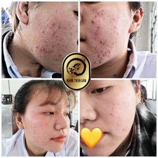 Serum Trị Mụn Hoàng Thiên Sâm