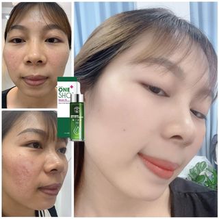 Trị mụn 24h