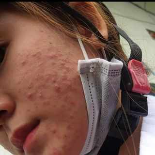 TRỊ MỤN NÁM TÀN NHANG THẢO DƯỢC QUYÊN LARA