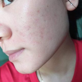 TRỊ MỤN NÁM TÀN NHANG THẢO DƯỢC QUYÊN LARA