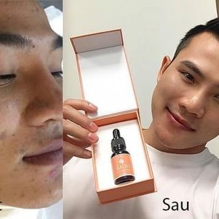 Serum trị mụn Dr.An+