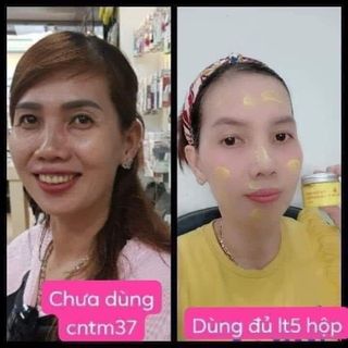 CAO TINH NGHỆ TRỊ MỤN MỜ NÁM TÀN NHANG