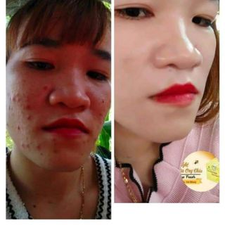CAO TINH NGHỆ TRỊ MỤN MỜ NÁM TÀN NHANG