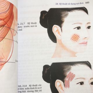 SÁCH - CĂNG DA MẶT BẰNG CHỈ Ở NGƯỜI CHÂU Á