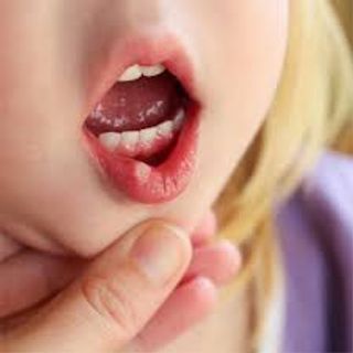 Kem Bôi Trị Nhiệt Miệng Trinolone_Oral_Paste