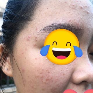 Dr Mai trị mụn nguyên chất