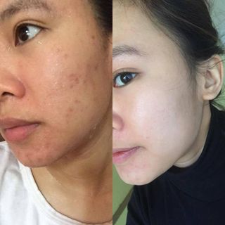serum trị mụn dr.an+