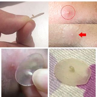 36 MIẾNG DÁN LẤY NHÂN MỤN - TRỊ MỤN