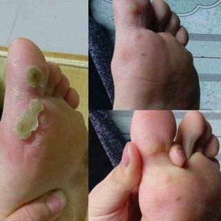 Đặc trị mụn cóc mụn thịt