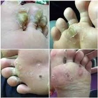 Đặc trị mụn cóc mụn thịt