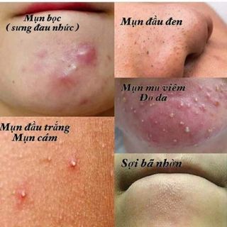 Kem chuyên mụn
