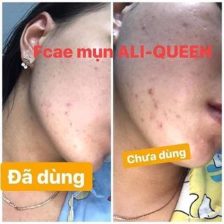 Kem chuyên mụn