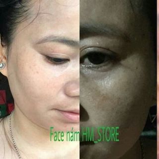 Face Nám Tàn Nhang
