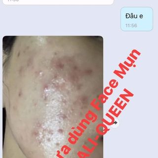 Kem chuyên trị mụn hiệu quả sau 7 ngày