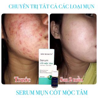 Trị Mụn Cốt Mộc Tâm