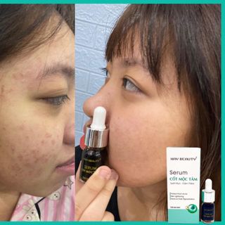 Trị Mụn Cốt Mộc Tâm