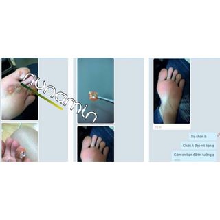 Thuốc trị mụn cóc Nunamin