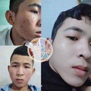COMBO TRỊ MỤN BÀ LÃO