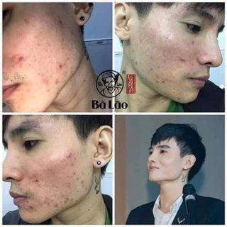 NAM DƯỢC TRỊ MỤN BÀ LÃO