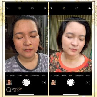 KEM TRỊ NÁM QUEENIE SKIN
