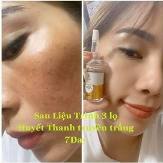 Truyền trắng olic 10ml