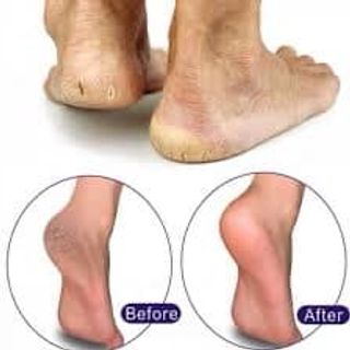 TRỊ NỨT GÓT CHÂN SULAMI