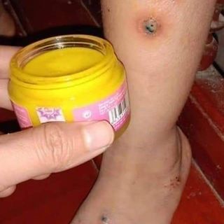 Kem đa năng Mul Rose trị mụn, viêm da cơ địa, mẫn ngứa, hăm sảy, rạn nứt da